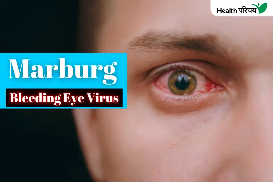 Deadly Marburg Virus Symptoms: More Severe Than COVID-19?